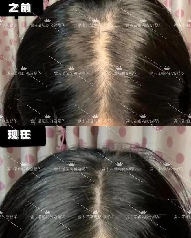 最新脱发治疗方法，重塑自信与美丽，从头开始！
